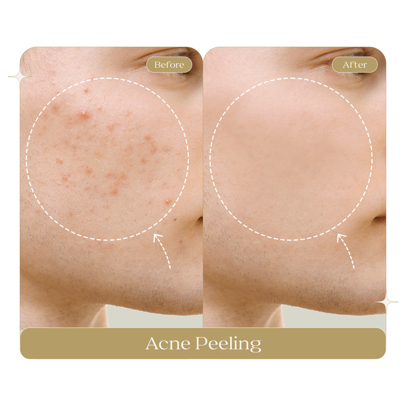 ACNE-PEELING