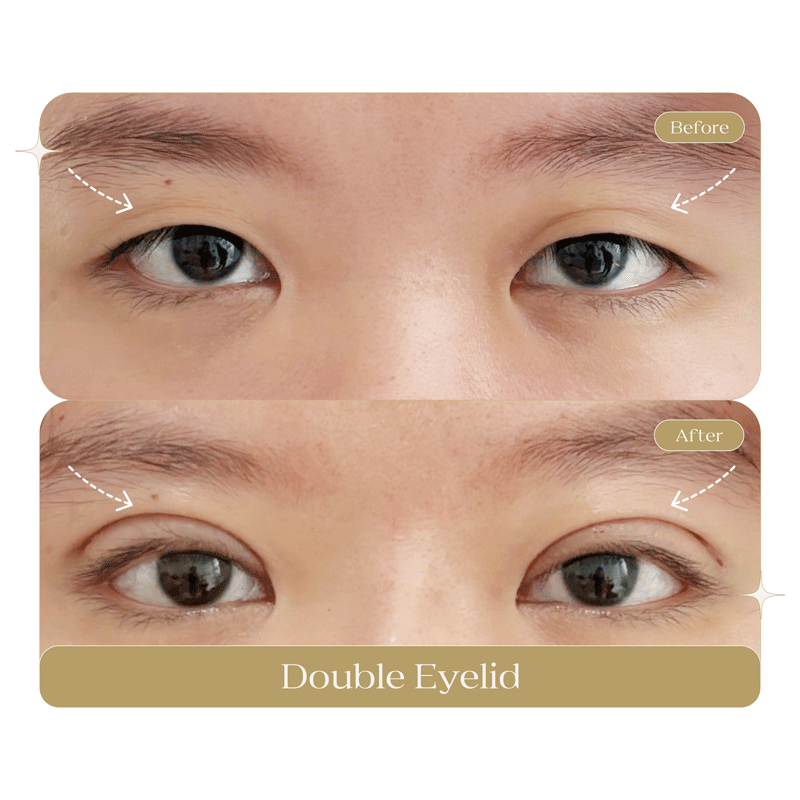 DOUBLE-EYELID-n