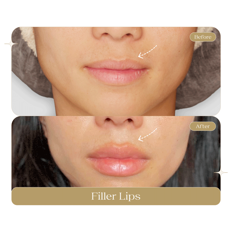 FILLER-LIPS