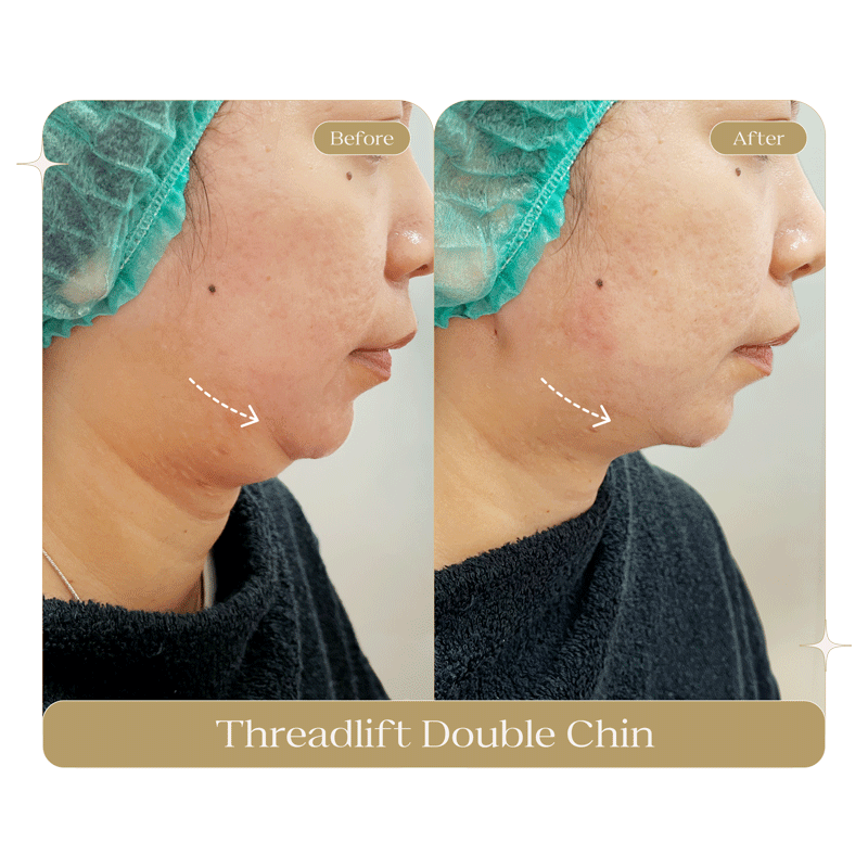 THREADLIFT-DOUBLE-CHIN