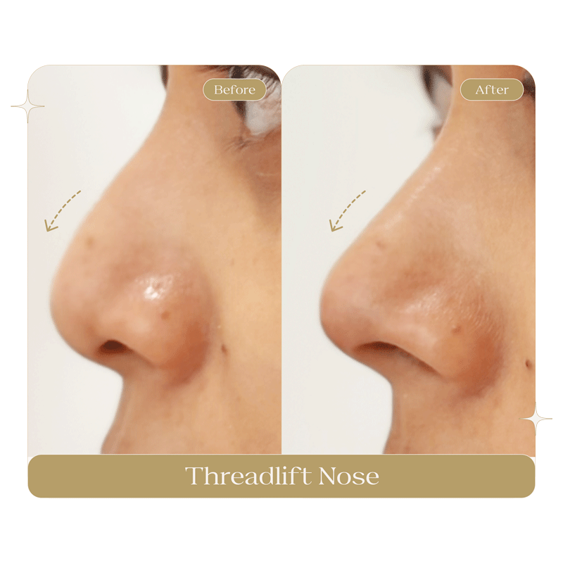 THREADLIFT-NOSE